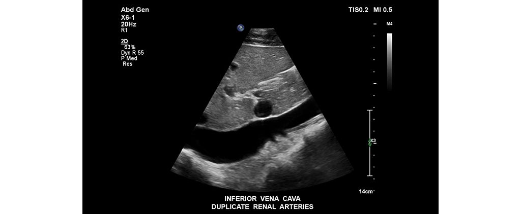 Inferior vena cava duplicate renal arteries