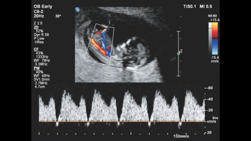 Affiniti 30 ultrasound clinical image obstetric early