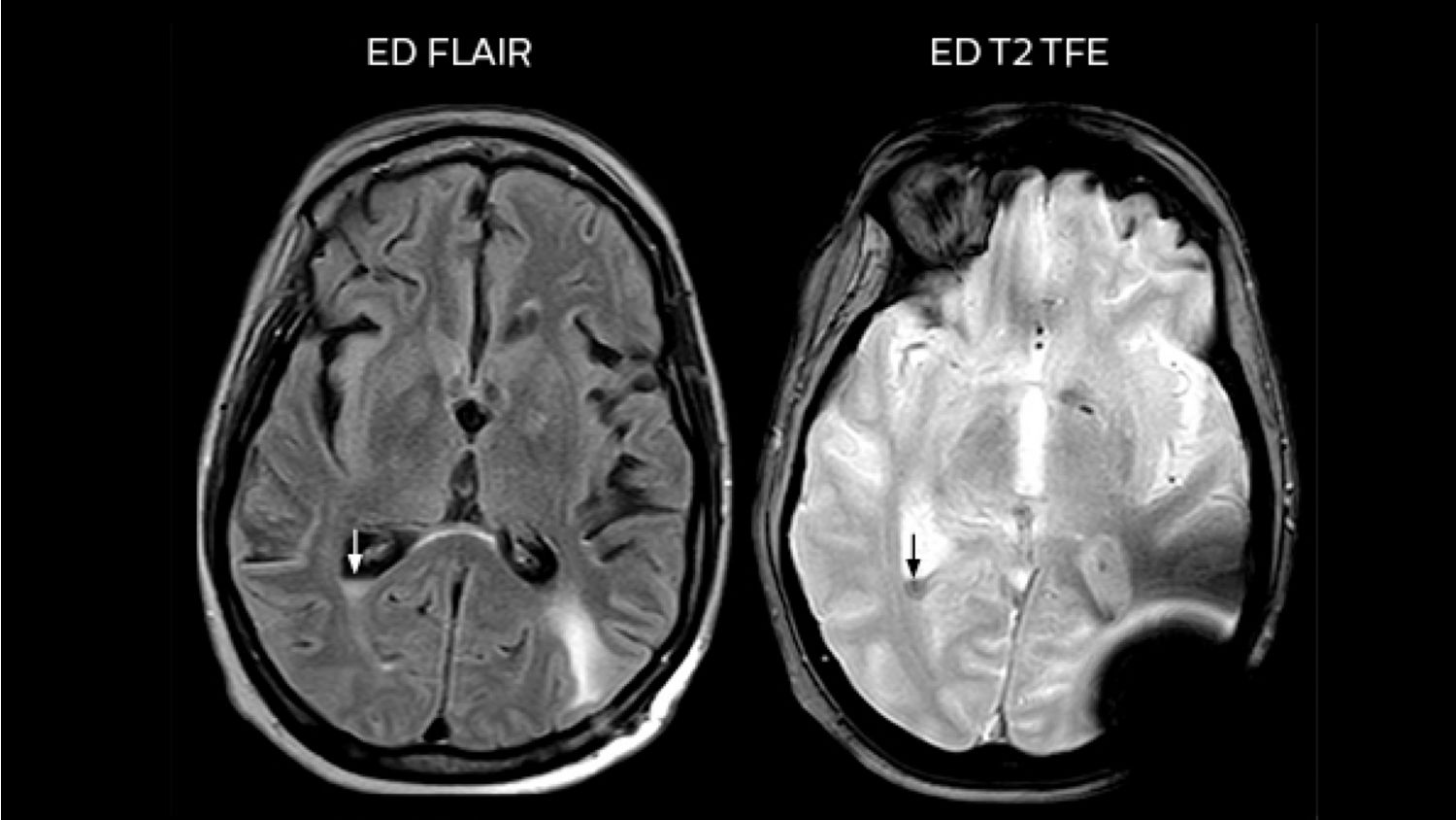 MRI helps uncover signs of meningeal carcinomatosis