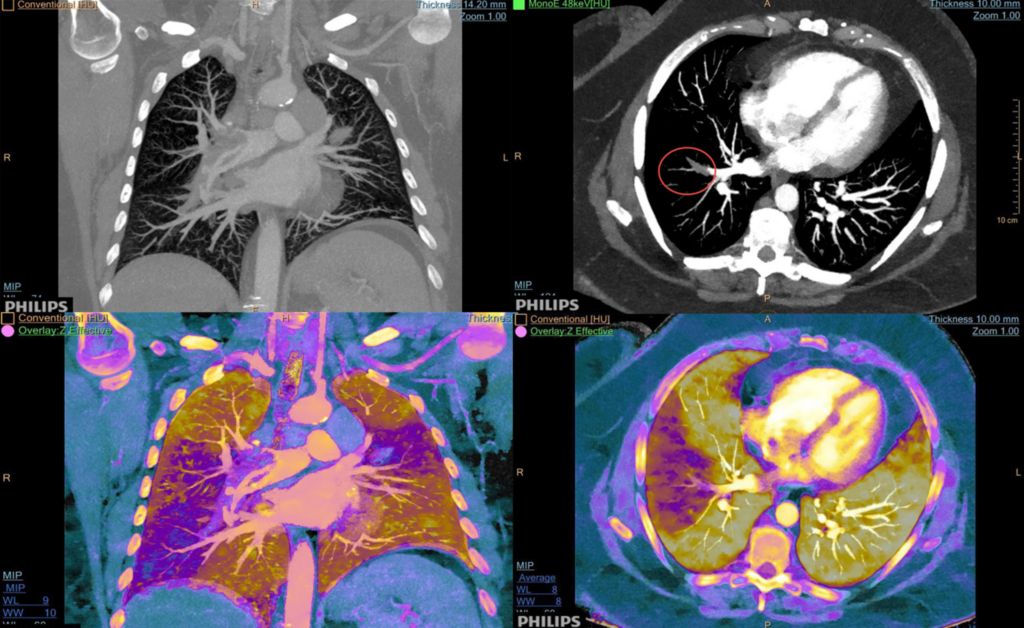 Right Lung Perfusion Deficit