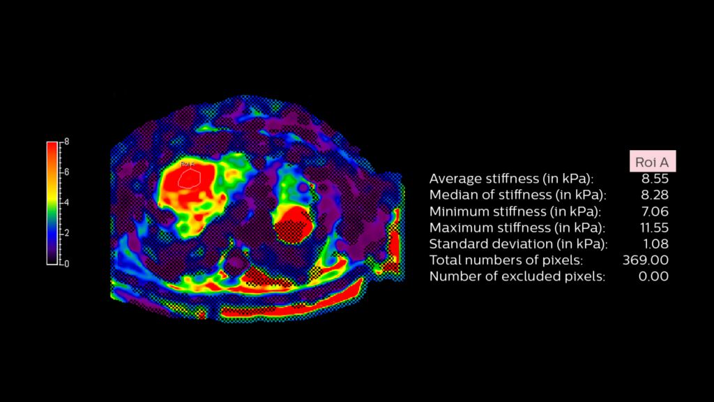 MR Elastography extension