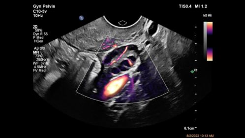 Ovary with MFI and Flow Viewer shown using a C10-3v transducer