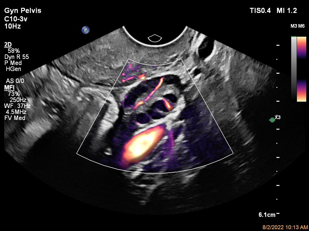Ovary with MFI and Flow Viewer shown using a C10-3v transducer