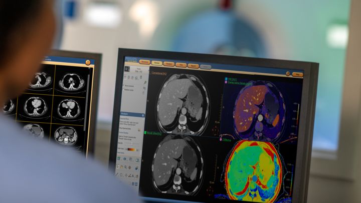 Spectral CT 7500 con paciente, imagen de exploración abdominal