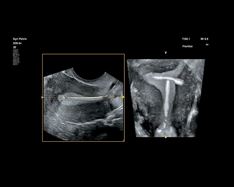 Uterine ultrasound image in coronal plane using FlexVue
