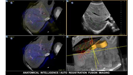 Voll integrierte, modalitätenübergreifende Bildfusion (US/CT/MR/PET)