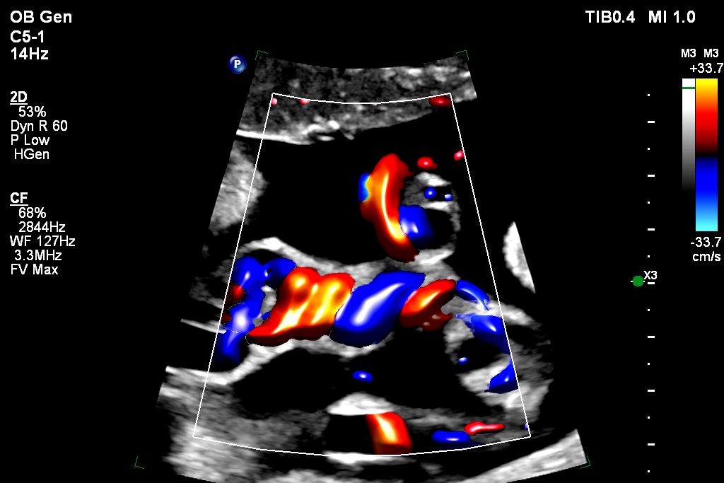 Umbilical cord shown with Color Flow with Flow Viewer using C5-1 transducer