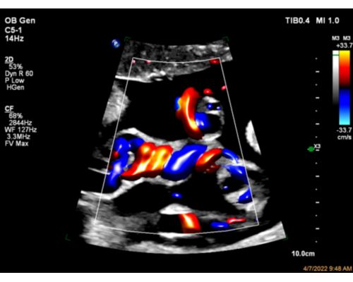 Umbilical cord shown with Color Flow with Flow Viewer using C5-1 transducer 