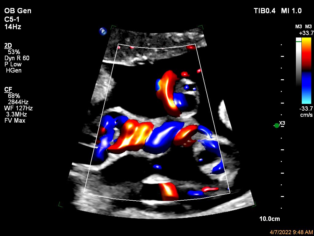 Umbilical cord shown with Color Flow with Flow Viewer using C5-1 transducer