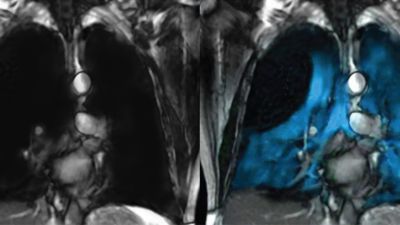 Polarean xenon contrast imaging of lung