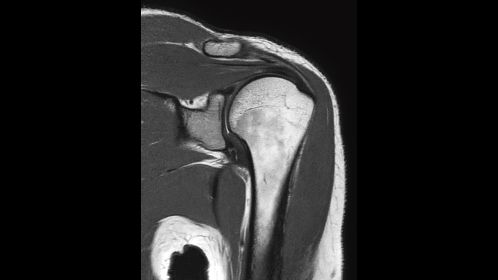 Coronal PDw aTSE - Shoulder
