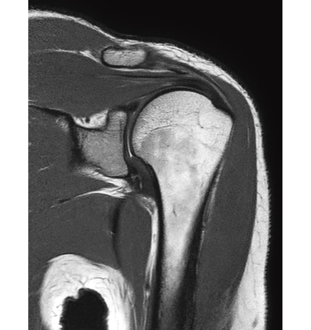 Coronal PDw aTSE - Shoulder