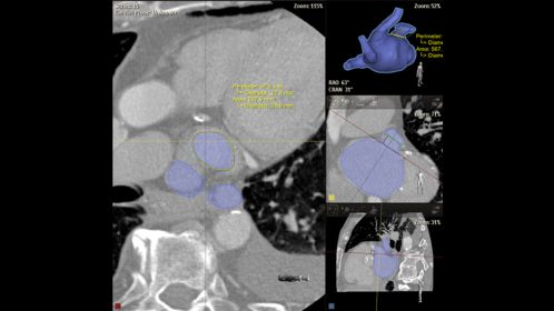 LAAC procedure planning