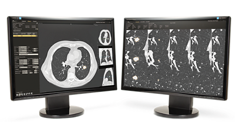 DynaCAD Lung Advanced visualization for CT chest exams