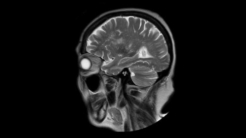 MultiVane XD - Sagittal T2w TSE