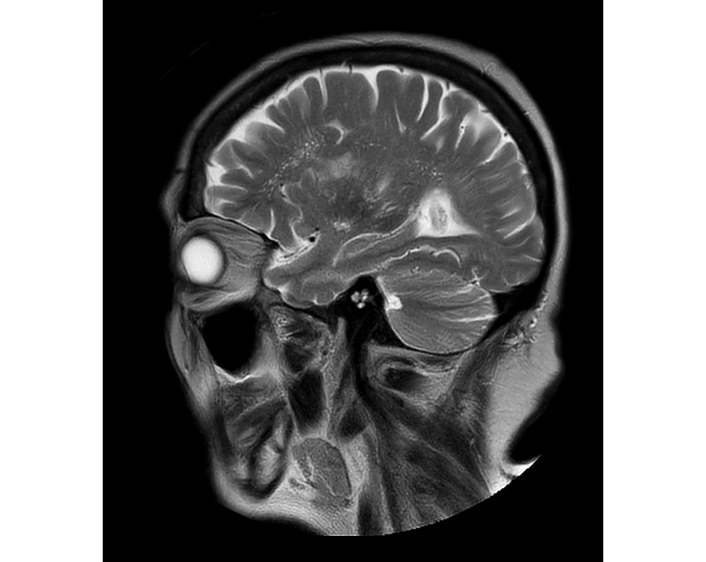 MultiVane XD - Sagittal T2w TSE
