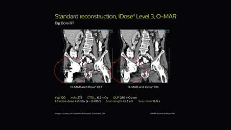 tool for planning healthcare advance kit Healthcare Bore scanner for Philips RT Big CT tool for planning healthcare advance kit Healthcare Bore scanner for Philips RT Big CT