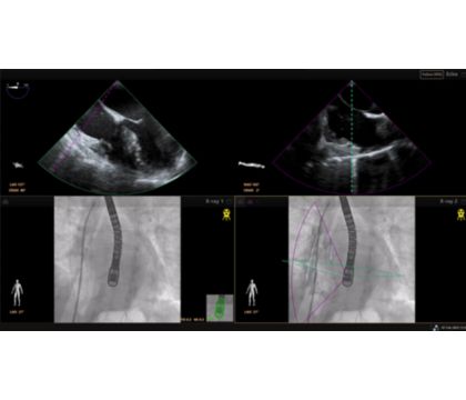 Case example EchoNavigator: transseptal puncture