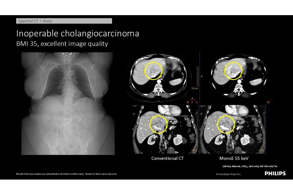 Spectral CT – Body