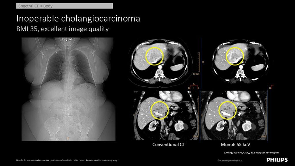 Spectral CT – Body