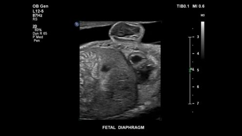 EPIQ ultrasound machine obstetric clinical image  of a fetal diaphragm