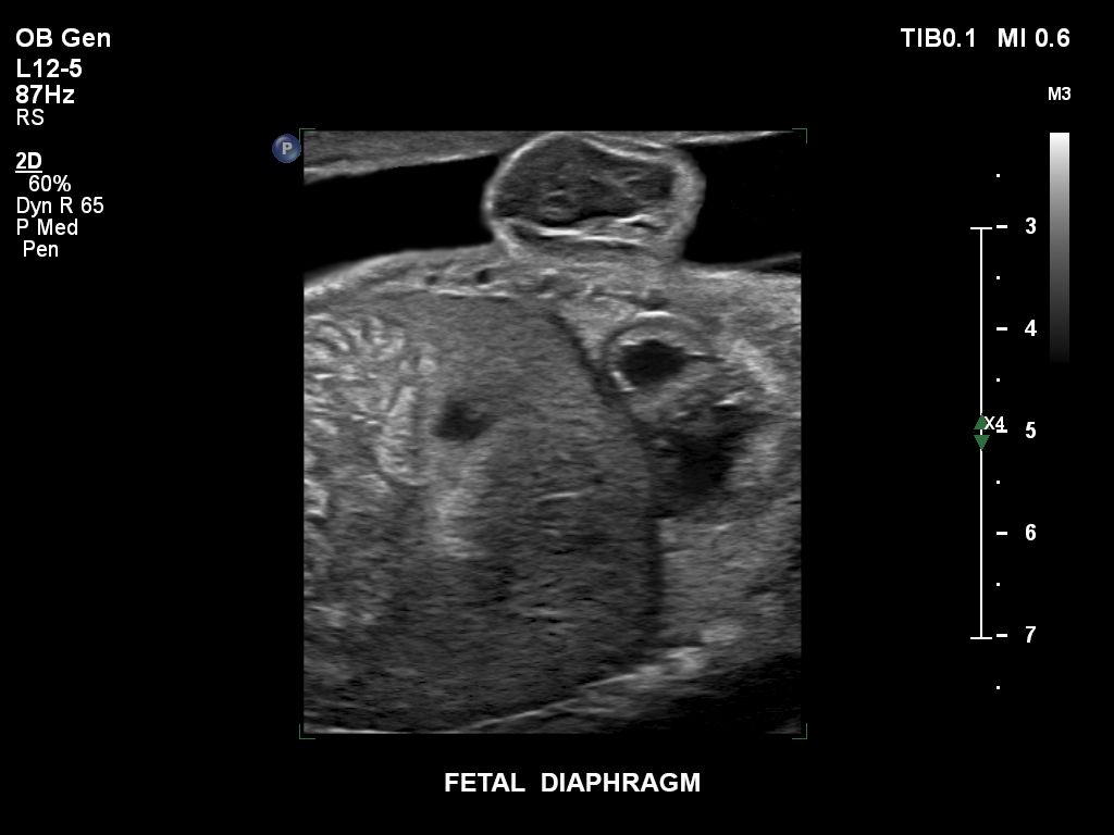 EPIQ ultrasound machine obstetric clinical image  of a fetal diaphragm