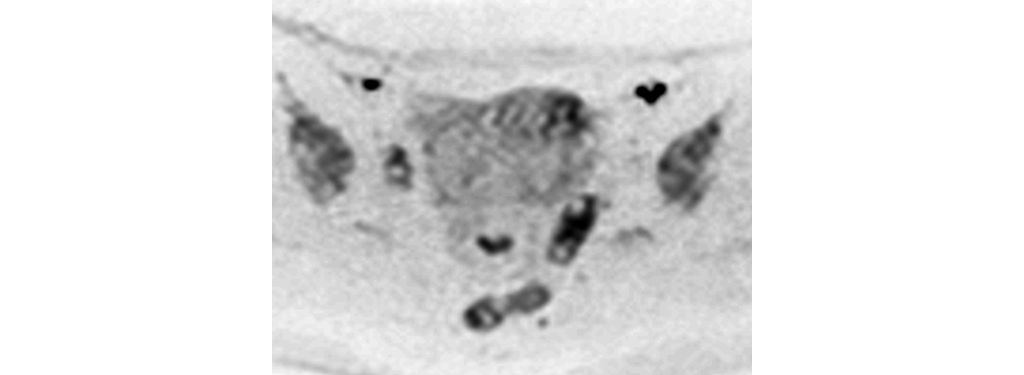 Axial Diffusion (b1500, female pelvis)