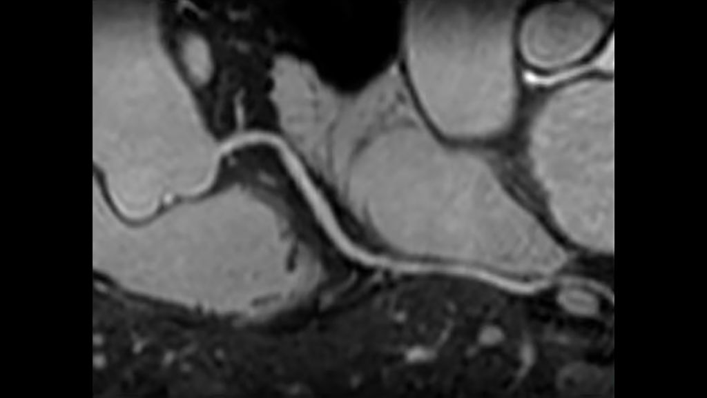 Coronary Acquisition