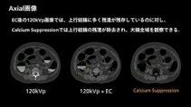 case 88
CT-colonographyにおけるカルシウム抑制画像の活用