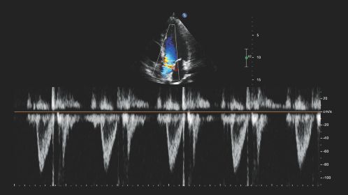 Left ventricular outflow tract