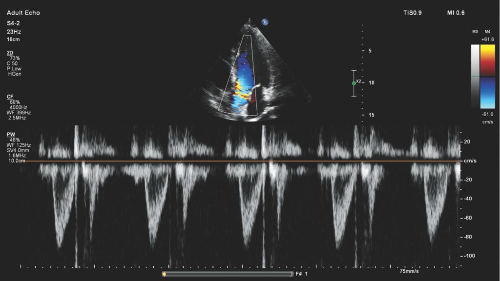 Left ventricular outflow tract with color and pulsed wave Doppler shown using S4-2 transducer on Compact 5000 Series  