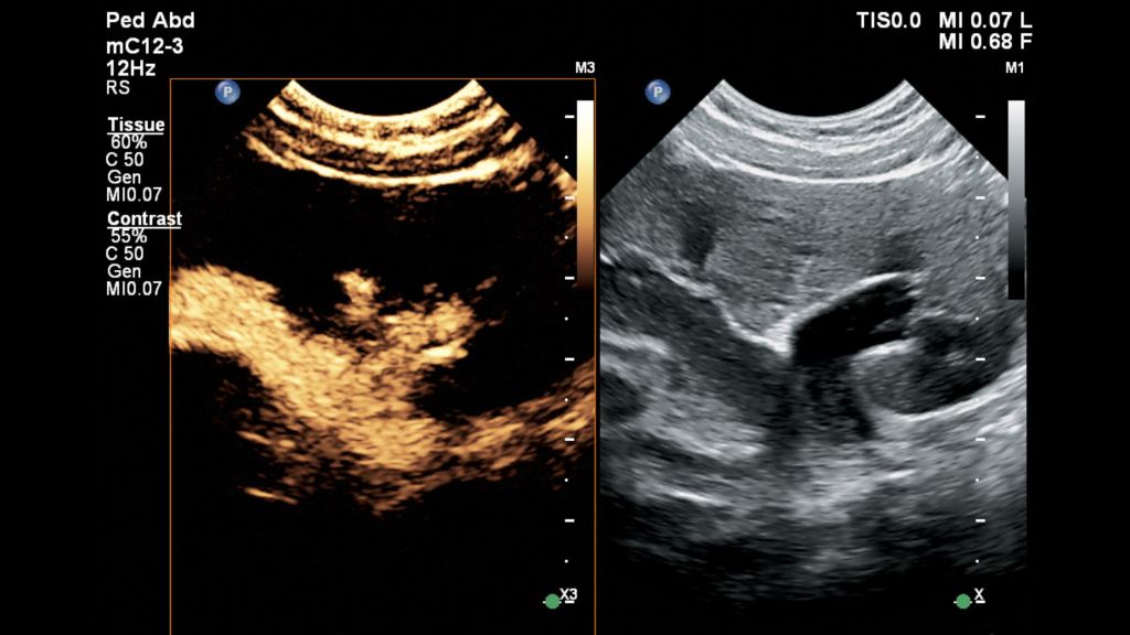 Pediatric bladder