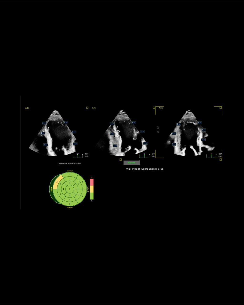 Segmental wall motion score ai software application interface