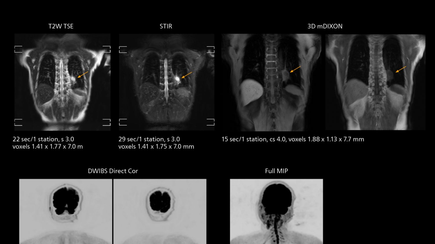 DWIBS imaging