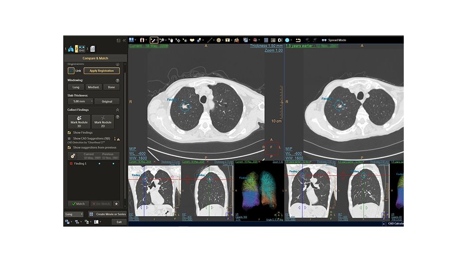 Semi-automated lung analysis using Philips IntelliSpace Portal advanced visualization