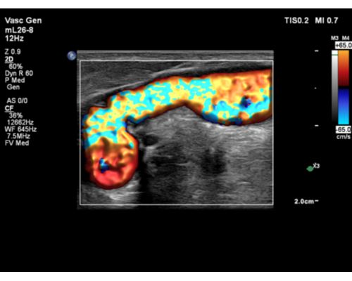 Abd Gen Renal MFI FV Path