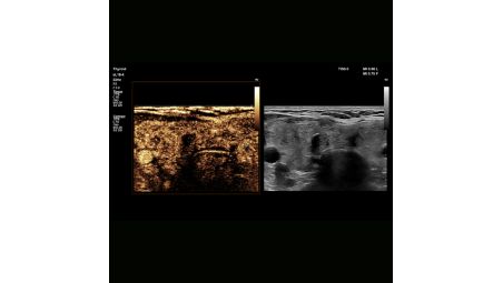 CEUS high frame rate linear & Auto Scan