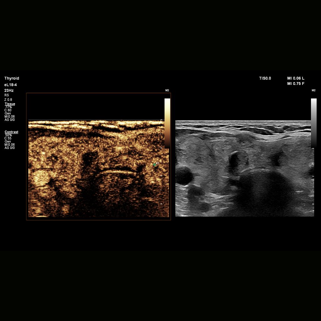 CEUS high frame rate linear & Auto Scan