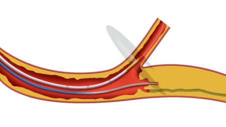 Perfil bajo para casos complejos