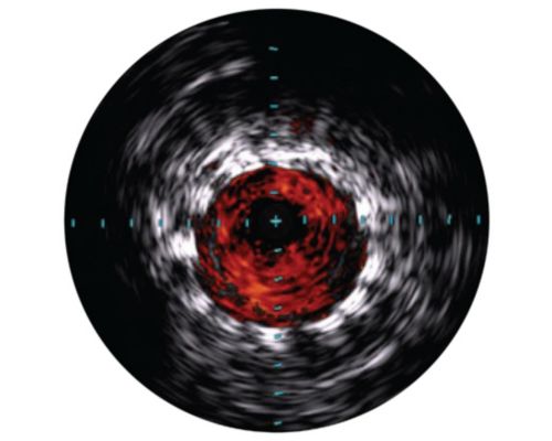 Philips Visions Peripheral .035 Digital IVUS catheter