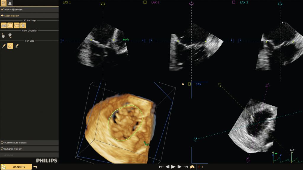 3D Auto Tricuspid Valve Quantification (3D Auto TV)​ supports accurate clinical evaluation of the tricuspid valve annulus in 3D.