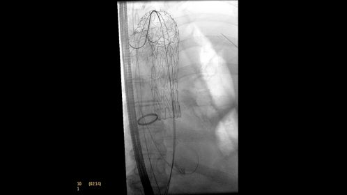 Clinical Image Philips Veradius Unity Mobile C-arm with Flat Detector