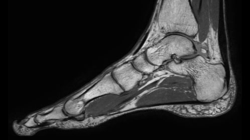 Sagittal 3D VIEW - PDw TSE