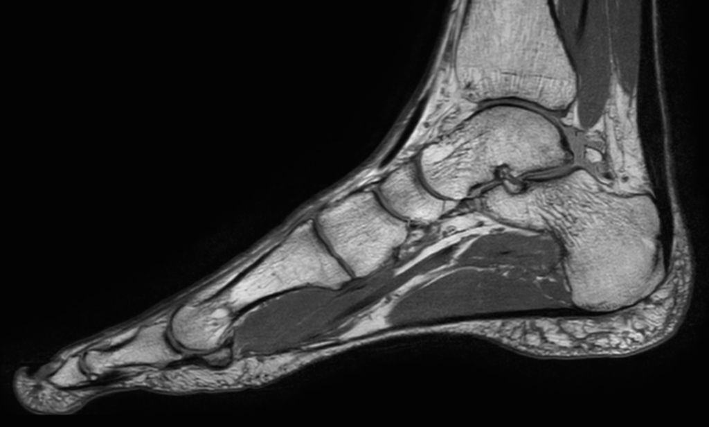 Sagittal 3D VIEW - PDw TSE