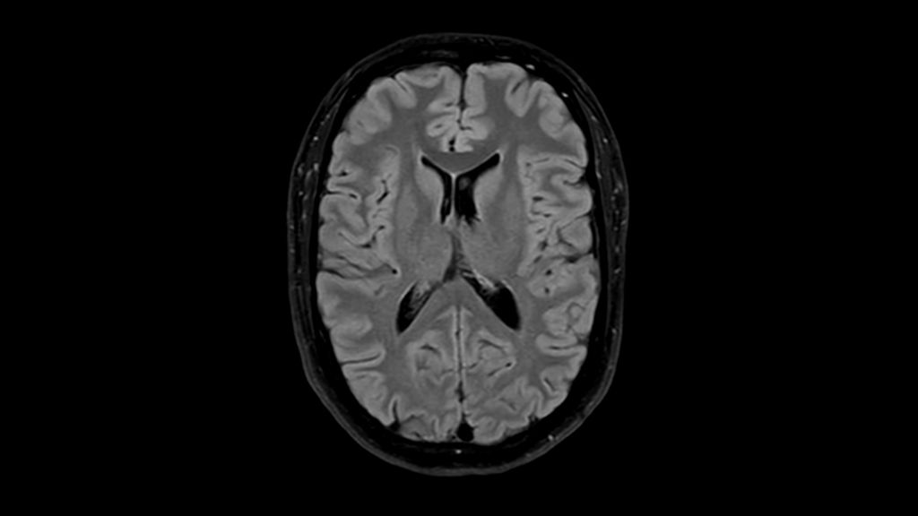 T2w FLAIR clinical image of the brain