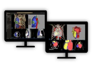 Multi Modality Advanced Vessel Analysis (AVA)​ Comprehensive vascular analysis planning