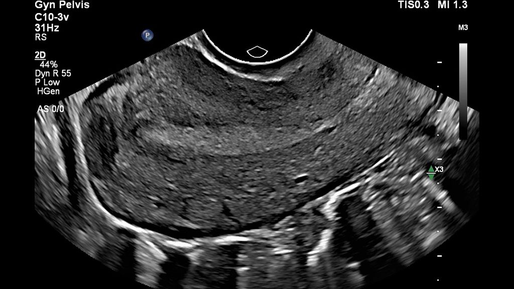 Sagittal image of the uterus using a C10-3v transducer