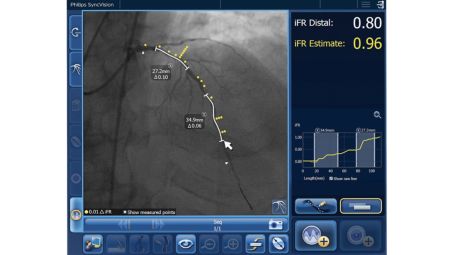 Only iFR has Co-registration for advanced physiologic guidance.