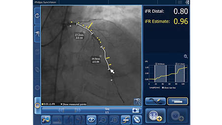 Only iFR has Co-registration for advanced physiologic guidance.