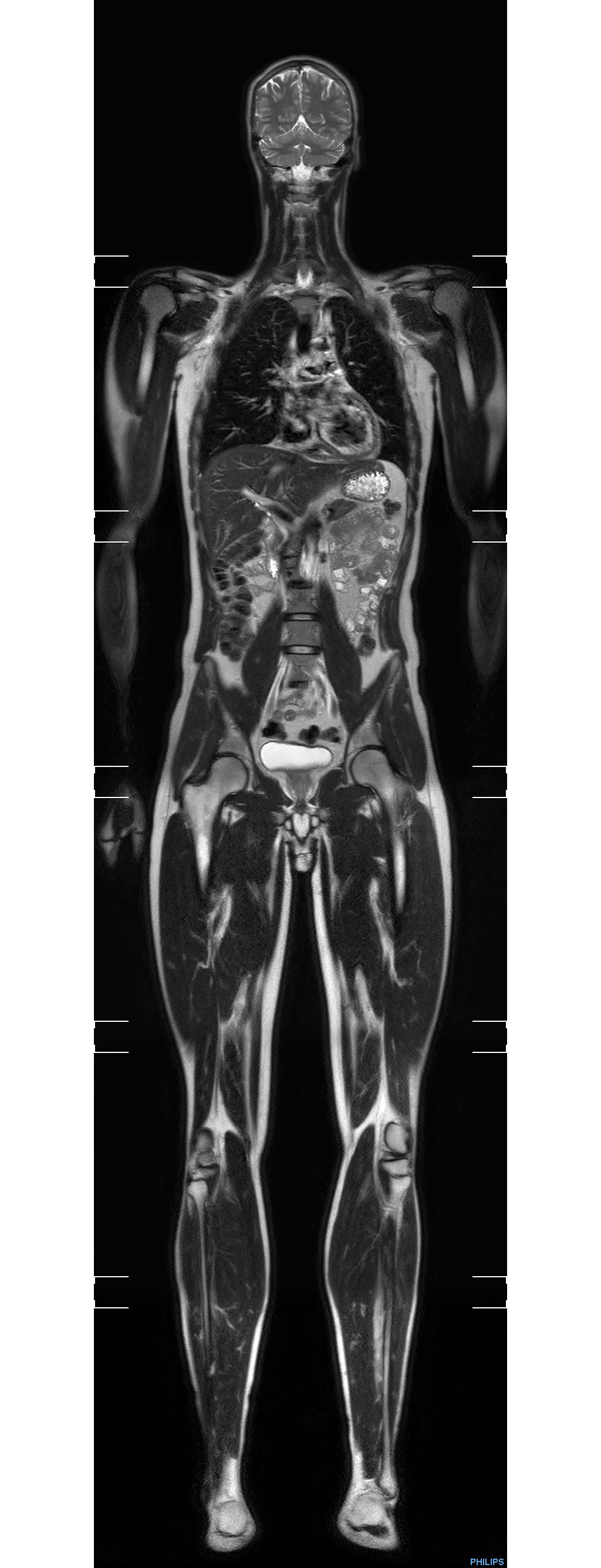 Coronal T2w TSE